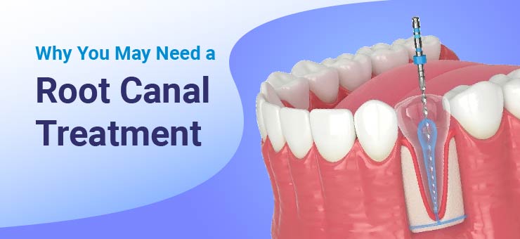 : Why You May Need a Root Canal Treatment