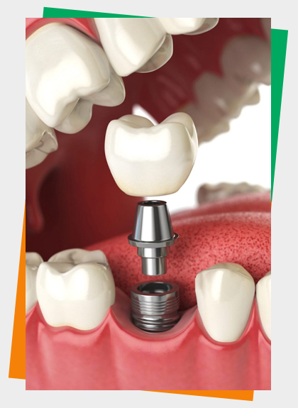 Implant Dentistry Clinic