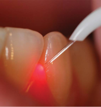 Laser Dentistry